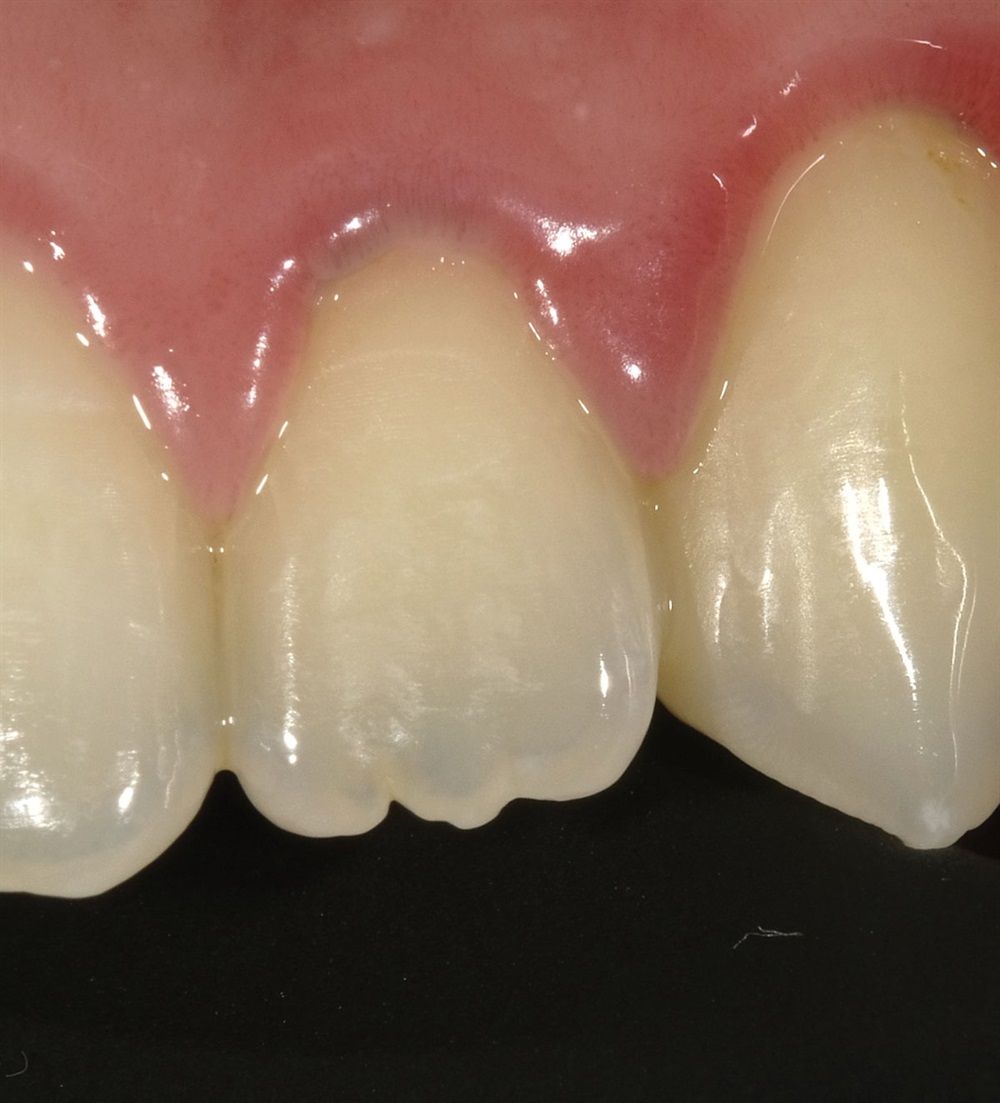 Show Your Work: Dental Restorations — Building Better Bonds